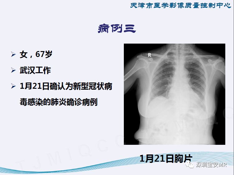 新型冠状肺炎最新情况深度解析